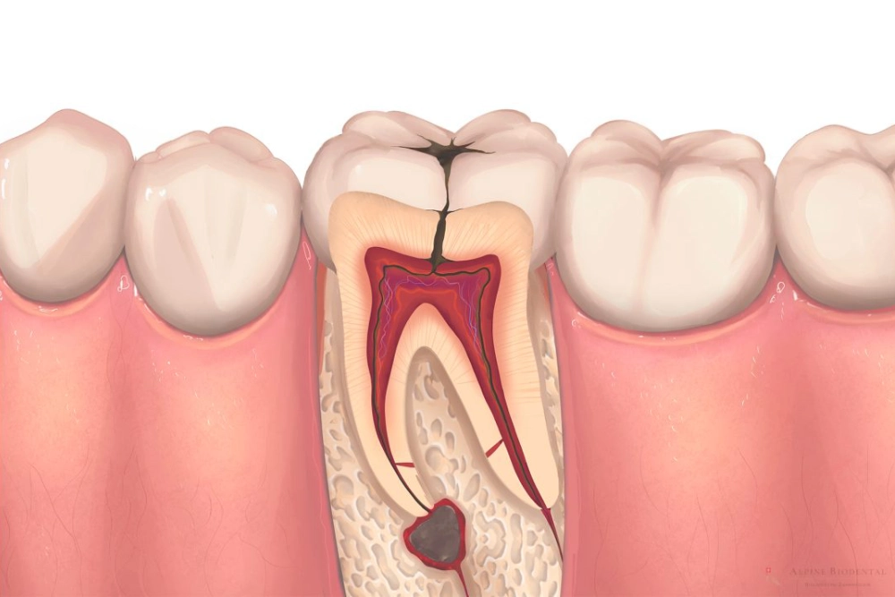 Root Canal Treatment (RCT)